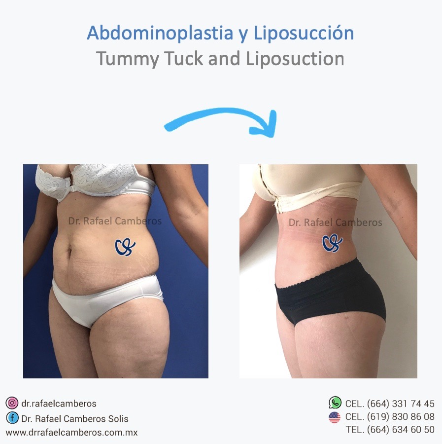 Abdominoplastia y liposuccion