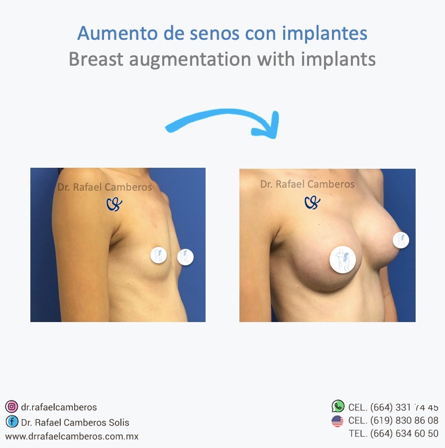 aumento de senos con implantes