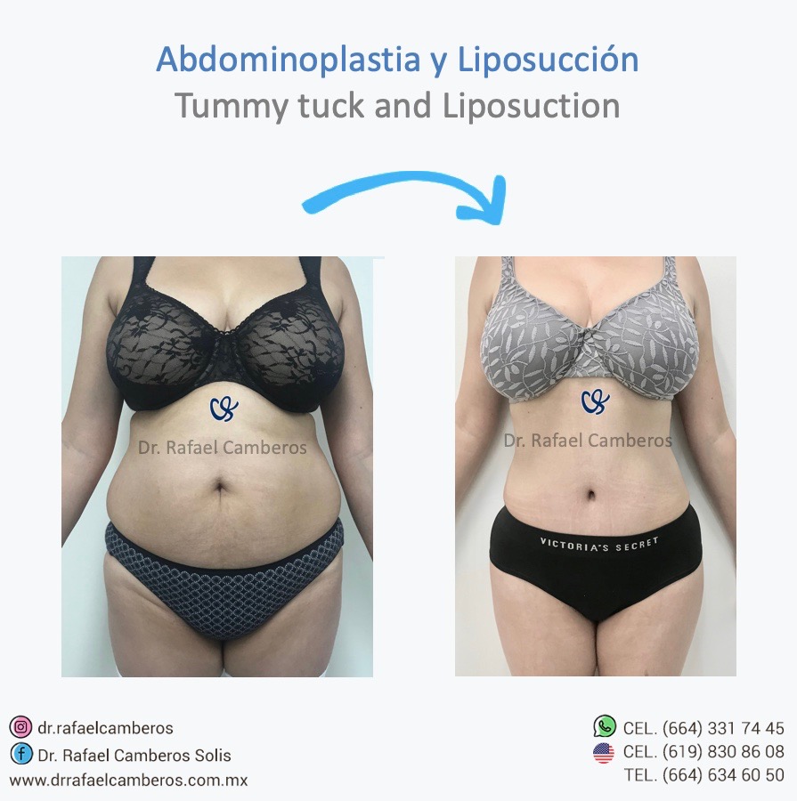 abdominoplastia y liposuccion