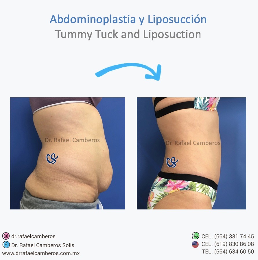 Abdominoplastia y liposuccion