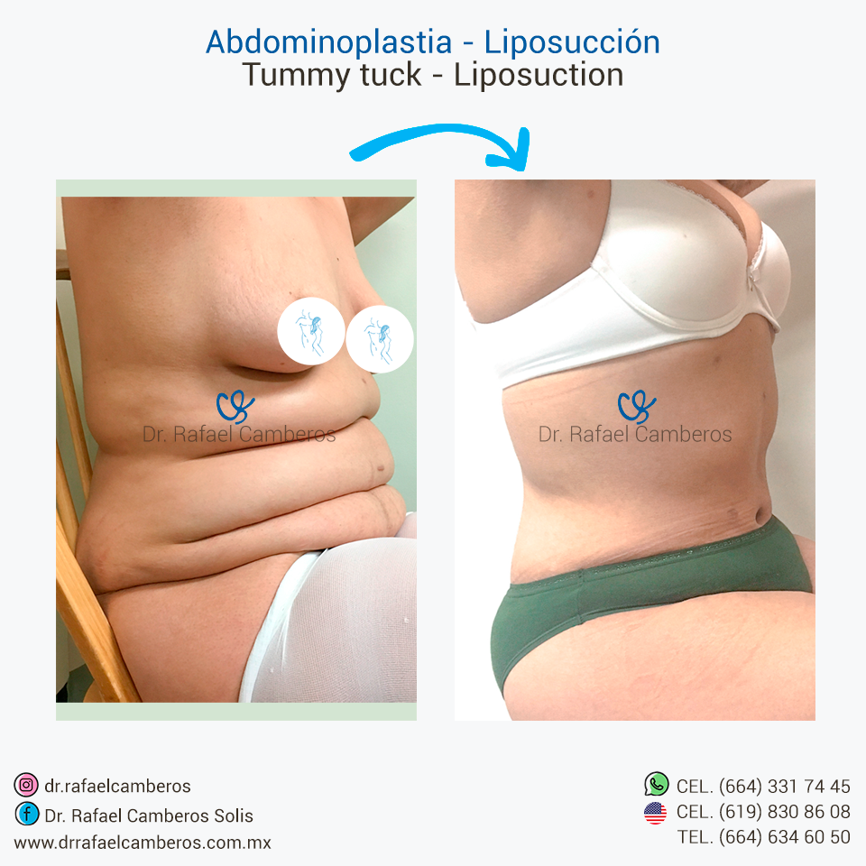 Abdominoplastia - Liposuccion