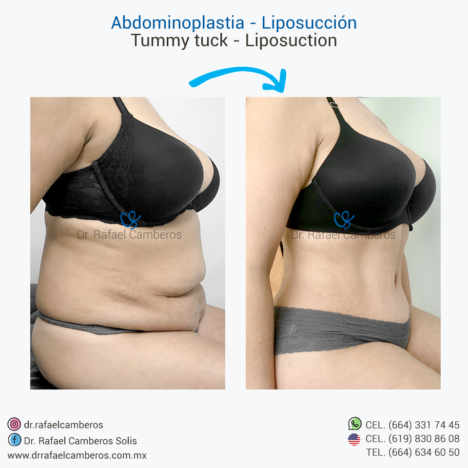 Abdominoplastia - Liposuccion