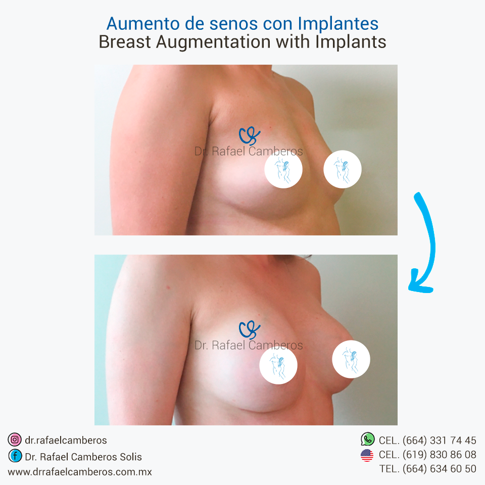 Aumento de senos con implantes